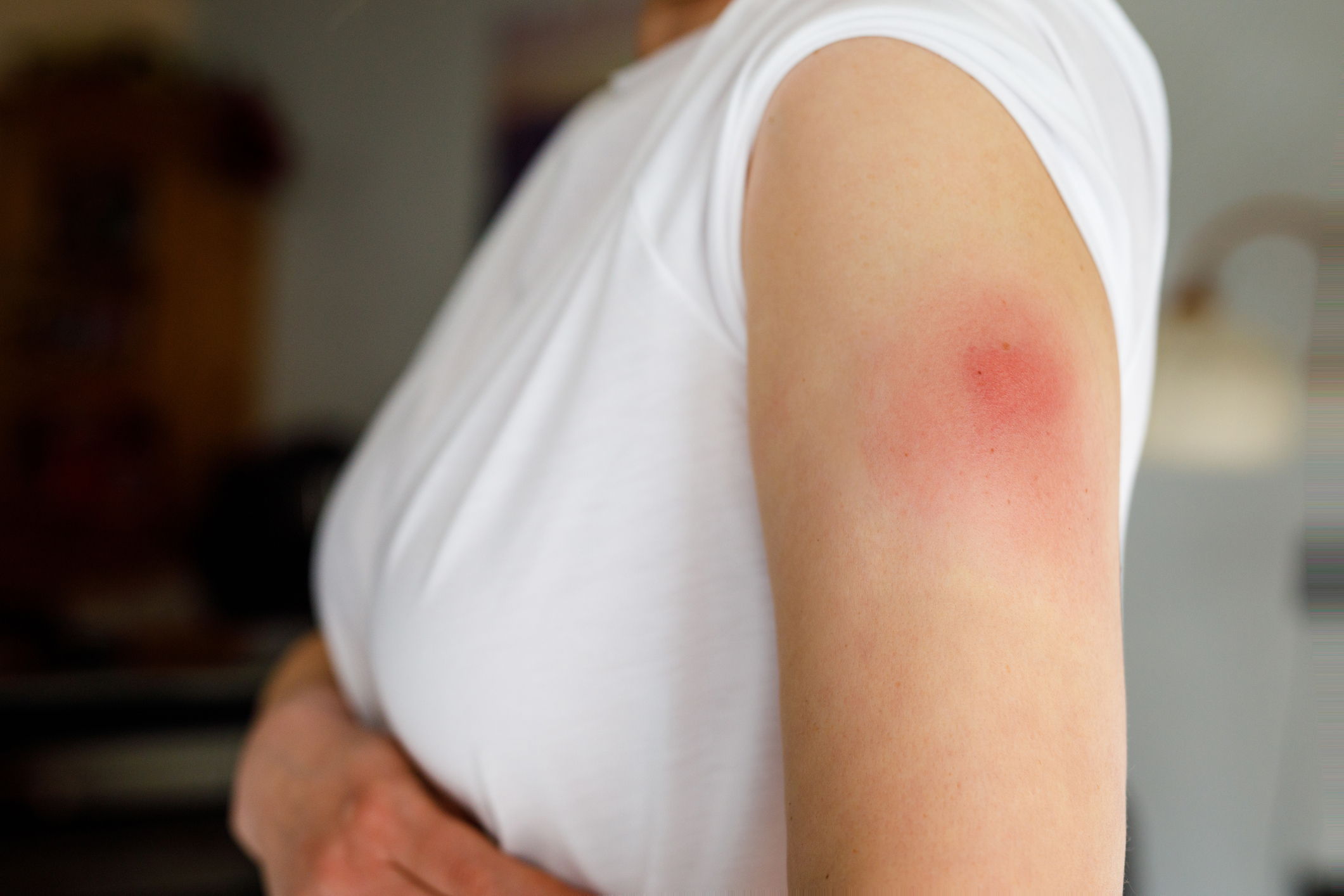 Staph Infections How To Avoid Them And How To Treat Them Summit Health